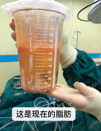 重慶星宸的吸脂技術決定了你抽大腿脂肪2000ml能瘦幾釐米!