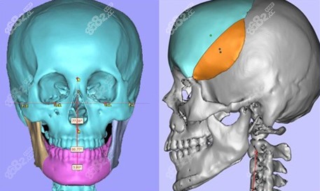 3D数字化外科技术可以三维建模让手术可视化