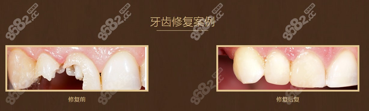 <!--<i data=20240705-sp></i>-->口腔找白桦做了单颗种植牙