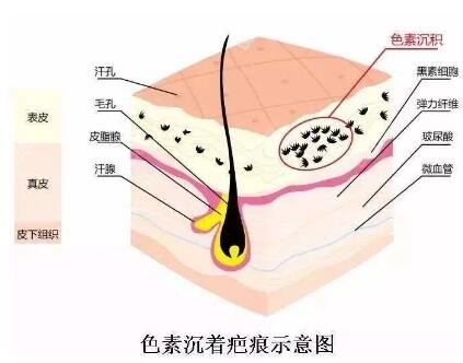 色素沉着疤痕示意图