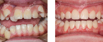 太原恒伦口腔隐适美牙齿矫正实例