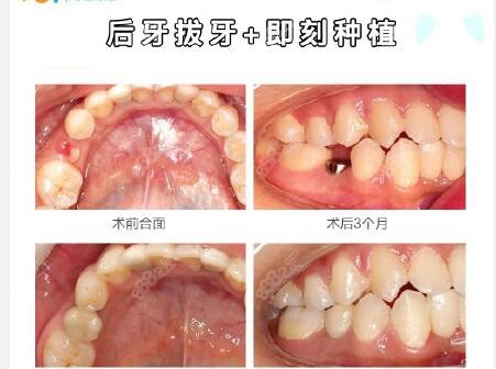 恒伦口腔即拔即种实例疗效