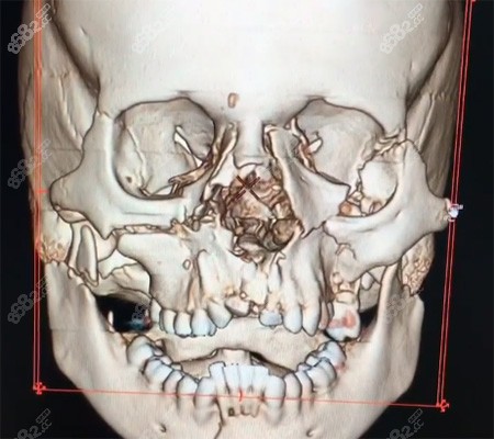 面部骨骼出现车祸损伤后影像图