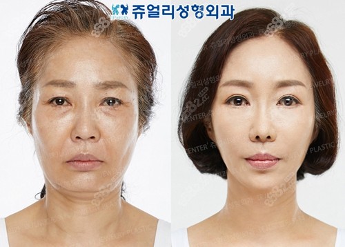 韩国珠儿丽拉皮手术术前术后对比