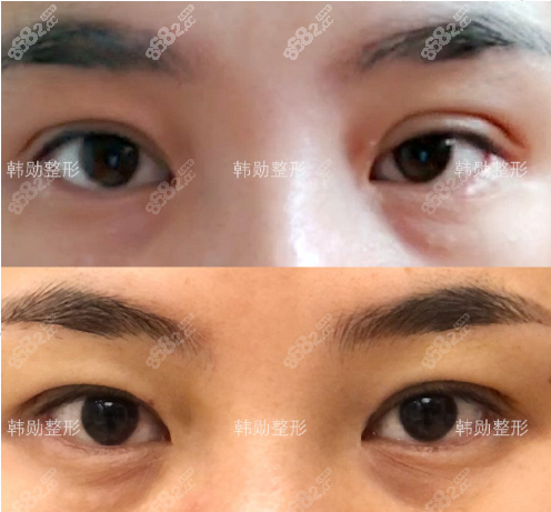 北京韩勋眼修复案例