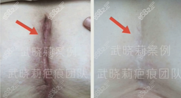 医生剖腹产疤痕增生治疗效果