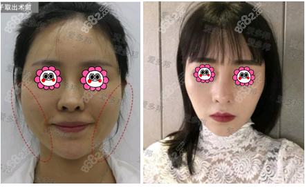 <!--<i data=20240705-sp></i>--><!--<i data=20240705-sp></i>-->脸部生长因子取出案例