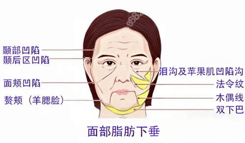 面部下垂解析图