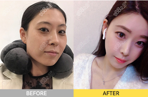 韩国珠儿丽下颌角整形术前术后对比