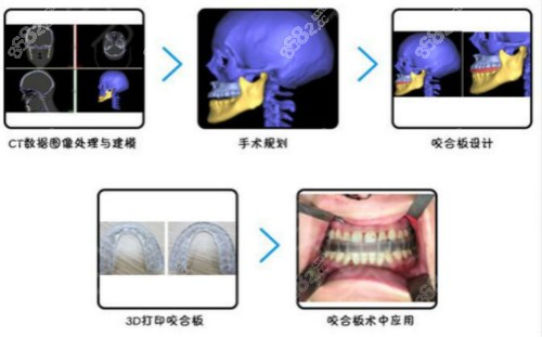 正颌手术怎么样