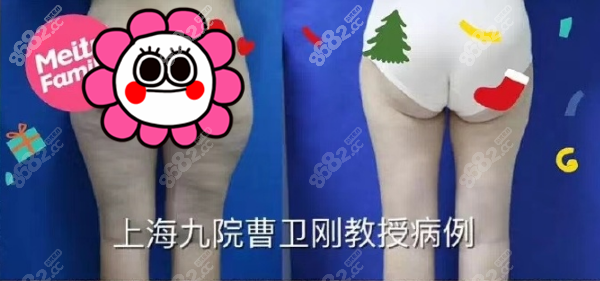 <!--<i data=20240705-sp></i>-->大腿吸脂案例 <!--<i data=20240705-sp></i>-->大腿吸脂案例