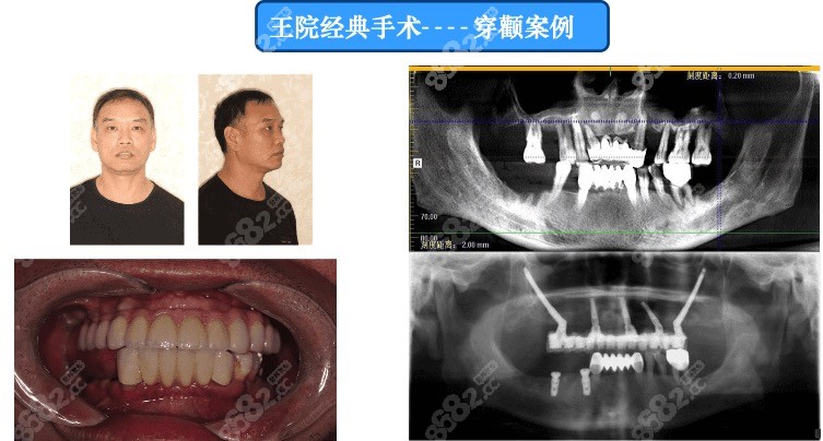 杭州美奥种植牙