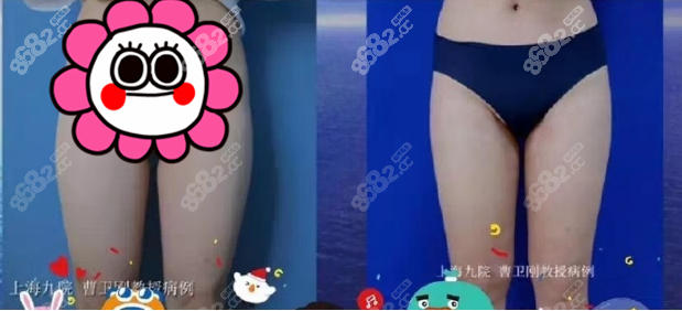 <!--<i data=20240705-sp></i>-->大腿吸脂案例圖3 <!--<i data=20240705-sp></i>-->大腿吸脂案例圖3