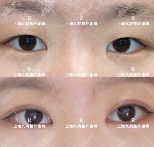 上海九院谢峰双眼皮手术术前术后对比