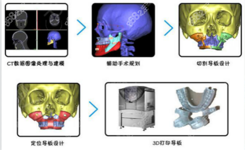 正颌手术技术优势