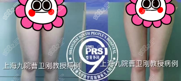 <!--<i data=20240705-sp></i>-->大腿吸脂案例圖2 <!--<i data=20240705-sp></i>-->大腿吸脂案例圖2