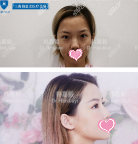 韩嘉毅鼻综合案例图