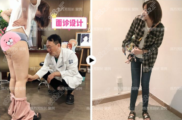 陈万芳大腿吸脂4000ml瘦四厘米8斤效果图