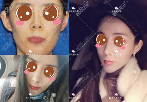 邱文苑鼻综合案例图