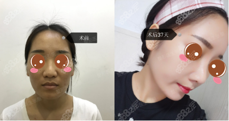 张朋鼻综合案例图