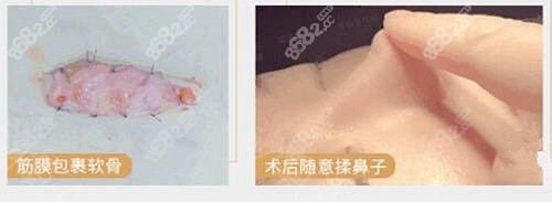 廖连平医生做鼻子的优势