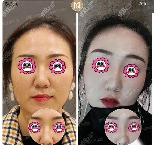成都美雅娜鼻综合效果对比图
