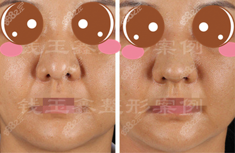 <!--<i data=20240705-sp></i>-->鼻综合案例图