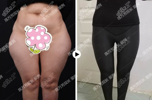 北京联合丽格大腿抽脂前后对比照片