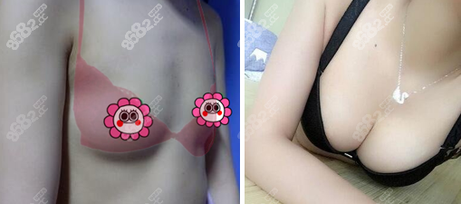 西京医院自体脂肪隆胸哪个好？易成刚自体脂肪丰胸案例参考