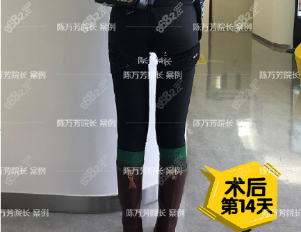 陈万芳吸脂术后照