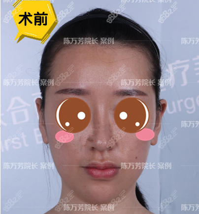 陈万芳自体脂肪面部填充术前照