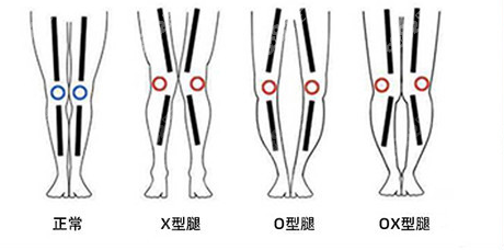 腿型不好示意图