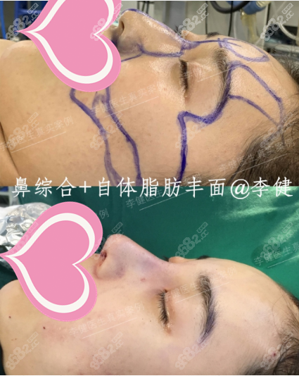 上海華美李健隆鼻案例