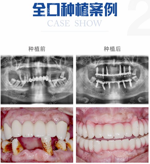 重庆8020口腔种植牙<span style=