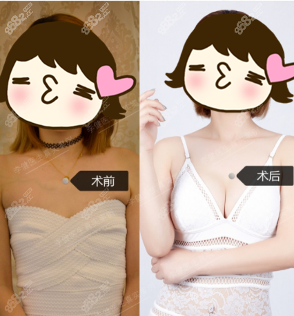 上海華美李健隆胸案例
