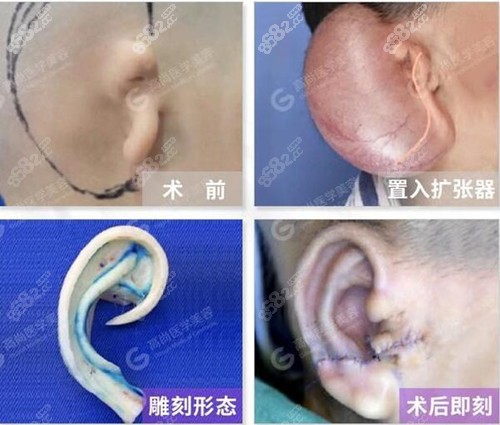 耳再造全包法手术过程