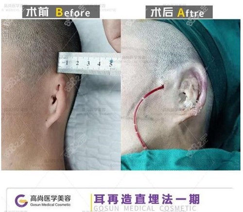 耳再造直埋法手术过程