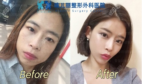 韩国珠儿丽整形医院下颌角手术案例