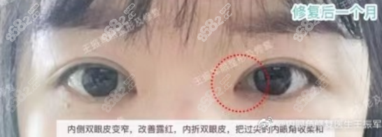 内眼角修复半年后的效果