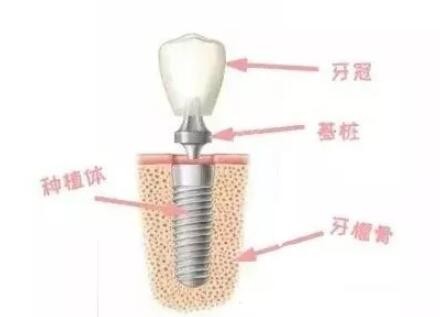种植牙的组成结构