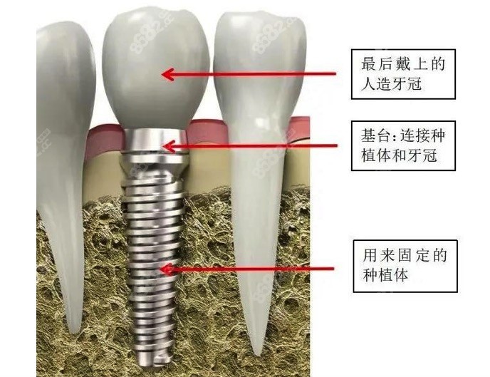 种植牙设备