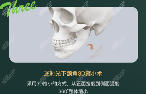 杭州时光医疗美容医院3D下颌角缩小术