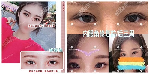 <!--<i data=20240705-sp></i>-->医生的内眼角修复案例