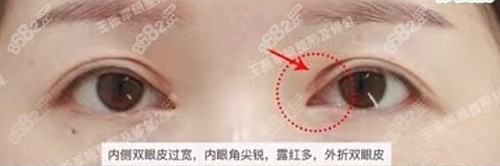 <!--<i data=20240705-sp></i>-->做内眼角修复怎么样