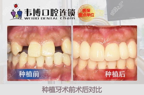 深圳韦博口腔种植牙<span style=