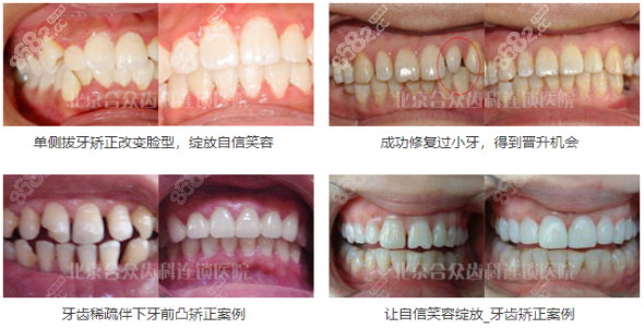 北京<!--<i data=20240705-sp></i>-->牙齿矫正案例