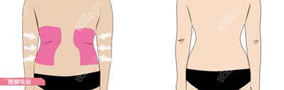 腰腹吸脂位置
