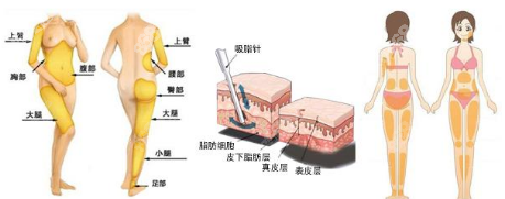 臀部吸脂动画图