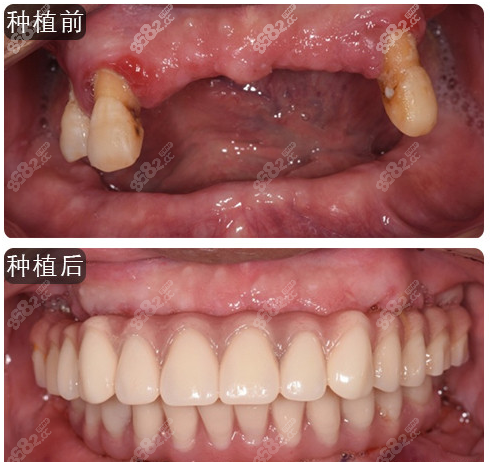 成都亚非牙科全口种植牙案例