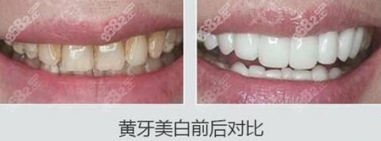 黄牙美白效果图